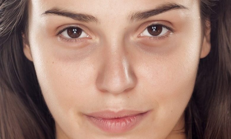 Confira 8 dicas de como remover olheiras